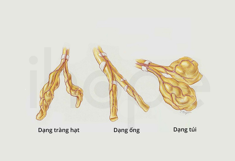 Bệnh giãn phế quản