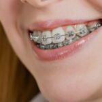 Niềng răng hô là gì? Quy trình, chi phí và những lưu ý quan trọng