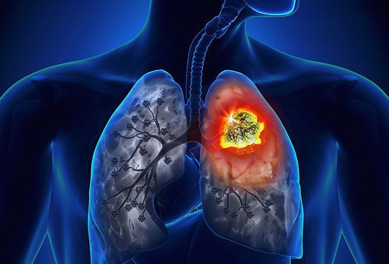 Di chứng sau khi điều trị bệnh lao
