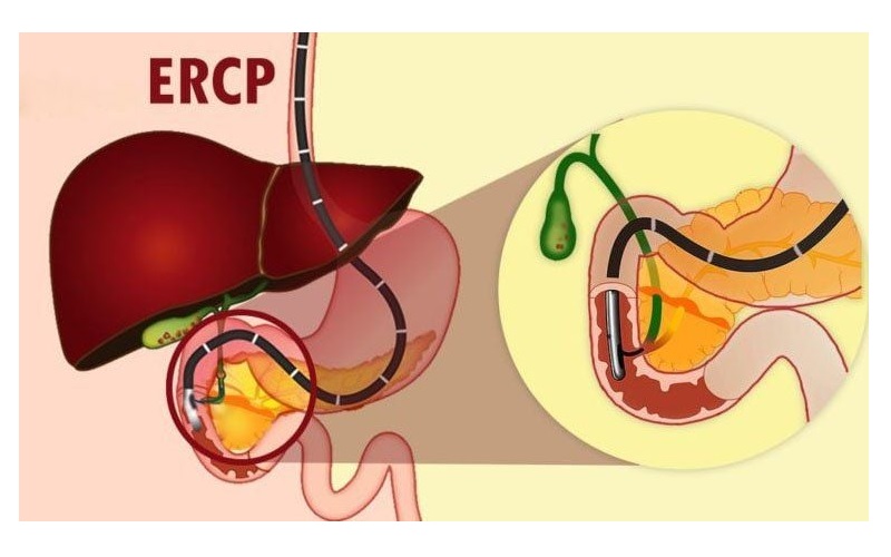 ERCP còn được áp dụng để tìm hiểu nguyên nhân gây ra các cơn đau kéo dài