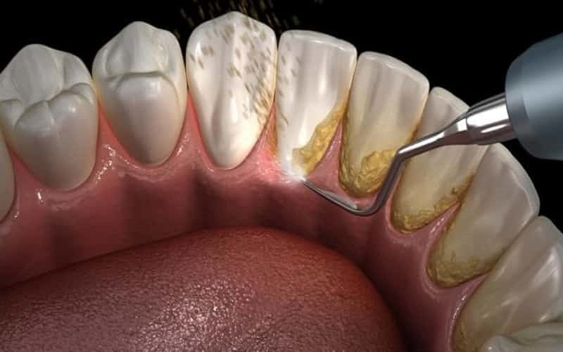 Răng lung lay có giữ được không với người già