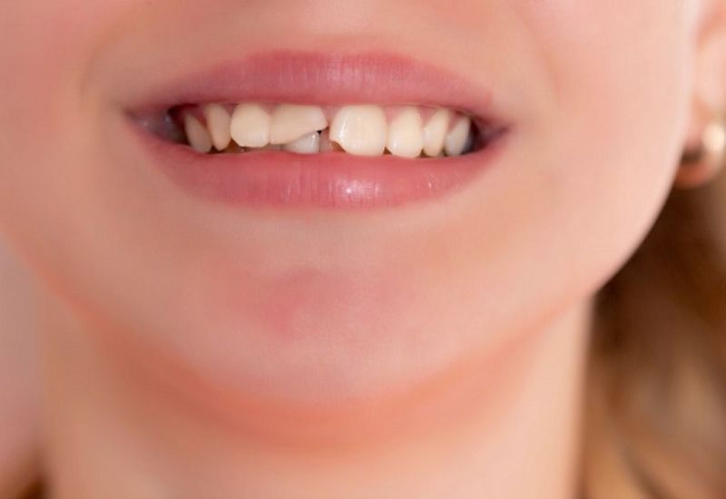 Nhiều người lựa chọn fun88 163 để khôi phục thẩm mỹ và chức năng răng một cách nhanh chóng.