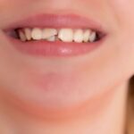 Những điều cần biết trước khi trám răng sứt để đạt hiệu quả lâu dài