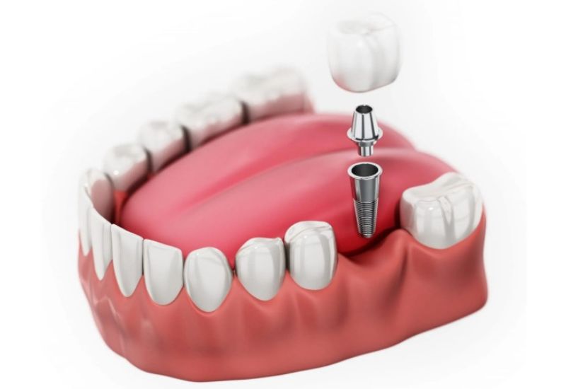 Trồng răng hàm là phương pháp phục hình phổ biến và được nhiều người lựa chọn.