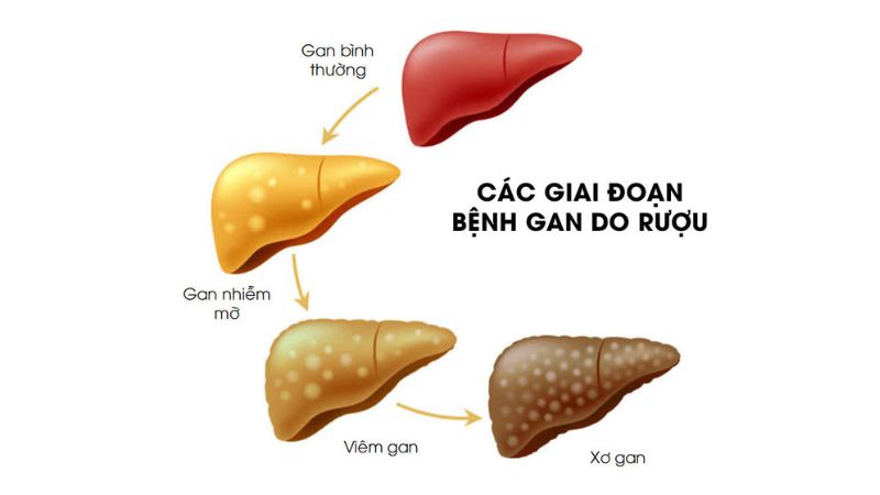 Viêm fun88 vin là bệnh gì?