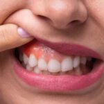 Tác hại lâu dài của viêm sưng lợi nếu không điều trị kịp thời