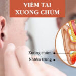 Viêm tai xương chũm – Bệnh lý cần cẩn trọng