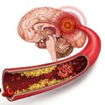 Xơ vữa động mạch và nguy cơ nhồi máu cơ tim, đột quỵ