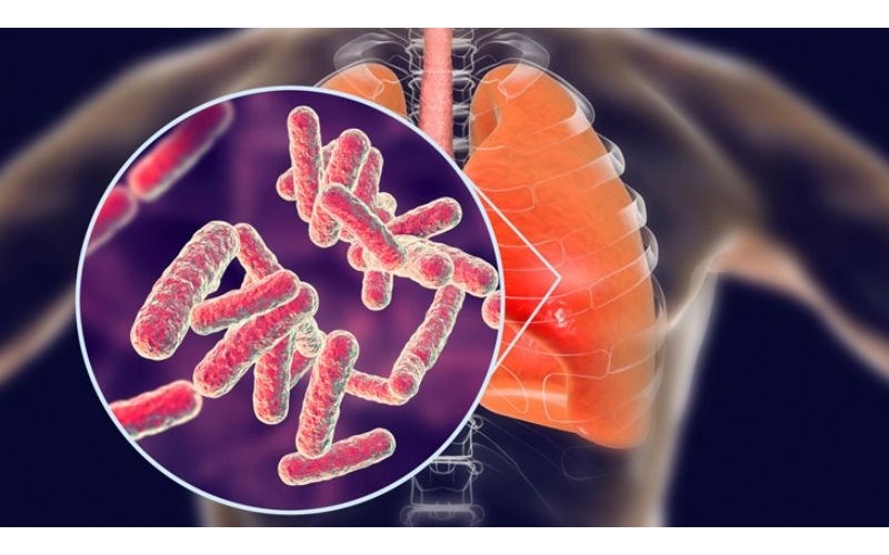 Bệnh lao phổi là một bệnh nhiễm trùng nghiêm trọng do vi khuẩn Mycobacterium tuberculosis gây ra