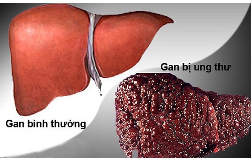Ung thư gan phải là một trong những bệnh lý ác tính nguy hiểm, tiến triển thầm lặng và thường chỉ được phát hiện khi đã ở giai đoạn muộn