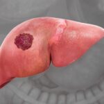 7 Nhóm đối tượng cần lưu ý tầm soát ung thư gan phải