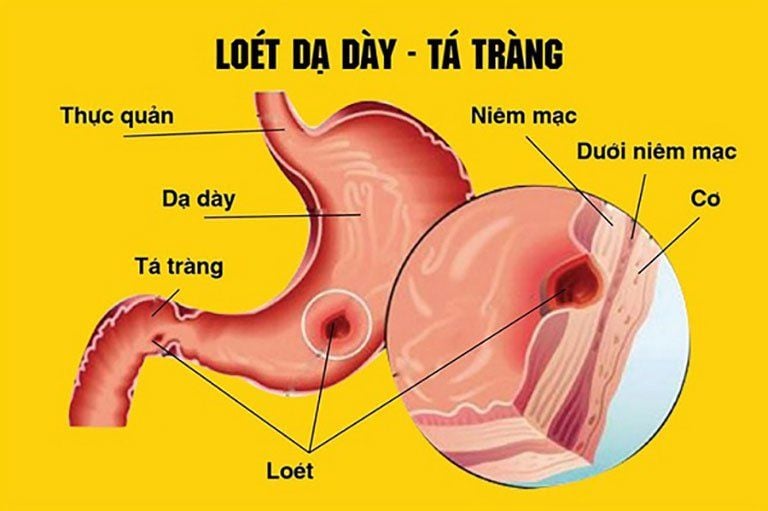 Viêm loét fun88 linkbong88moinhat gây thiếu máu là tình trạng phổ biến, có thể dẫn tới biến chứng nguy hiểm.