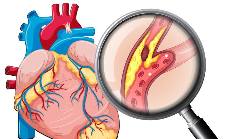 Bệnh mỡ máu có nguy hiểm không nếu điều trị muộn?