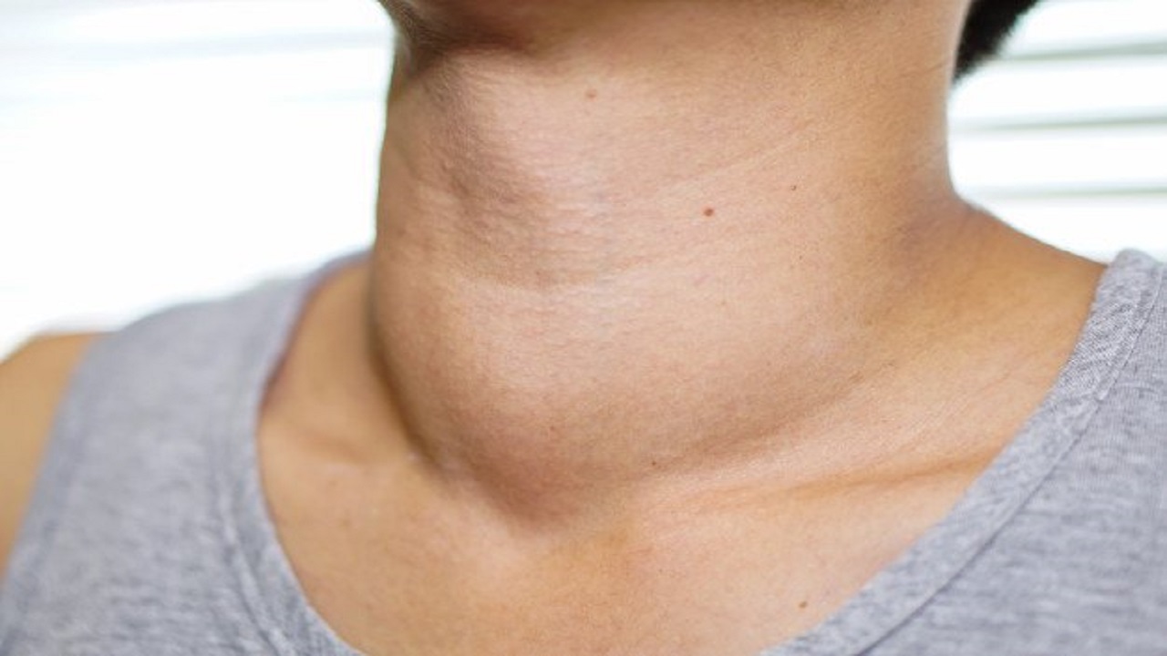 Những dấu hiệu cảnh báo bị bệnh cường giáp