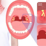 Bị viêm amidan – Dấu hiệu và những lưu ý cần thiết