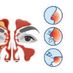 Những dấu hiệu cảnh báo bị viêm xoang và cách điều trị