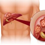 Biến chứng nguy hiểm của bệnh ung thư gan