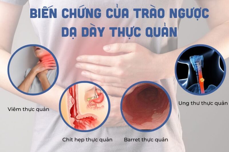 Biến chứng trào ngược dạ dày thực quản rất nguy hiểm.