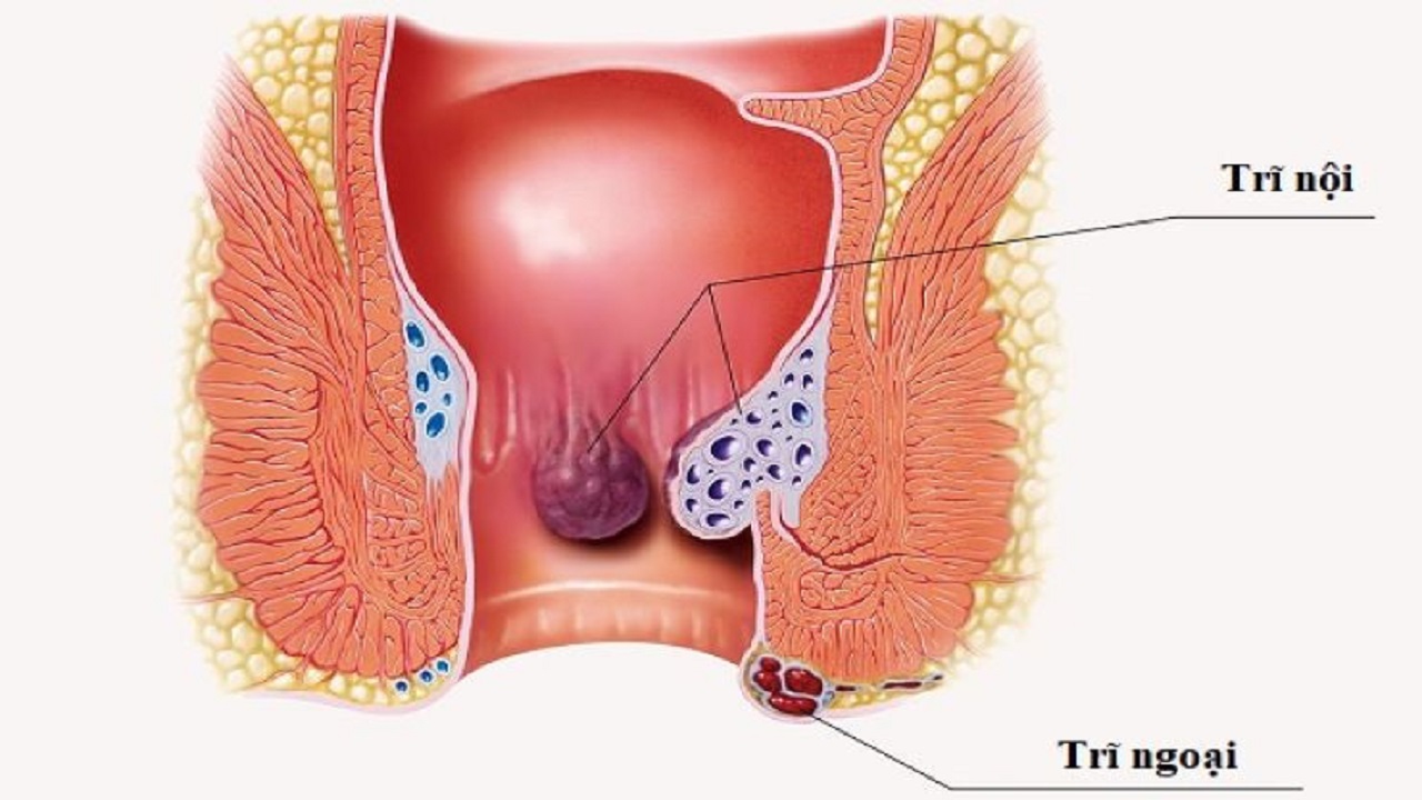 biểu hiện của trĩ ngoại