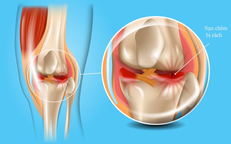 Sự sưng tấy thường đi kèm với cảm giác nóng ran và căng tức ở đầu gối