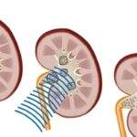 Cách điều trị sỏi tiết niệu bằng công nghệ tán sỏi hiện đại