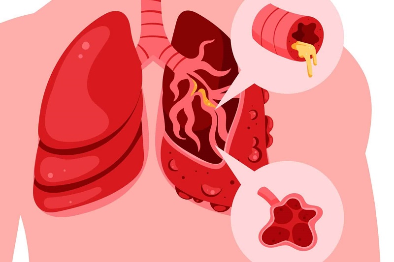 người mắc bệnh phổi tắc nghẽn mạn tính copd cần duy trì lối sống khoa học