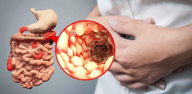 Nếu có dấu hiệu bất thường liên quan đến đường ruột, cần thăm khám sớm để chẩn đoán bệnh lý nguyên nhân, trong đó có bệnh Crohn.