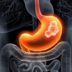 Cùng tìm hiểu 5 phương pháp điều trị ung thư dạ dày