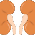 Vì sao bị đài bể thận giãn độ 3: Cơ chế và các yếu tố nguy cơ