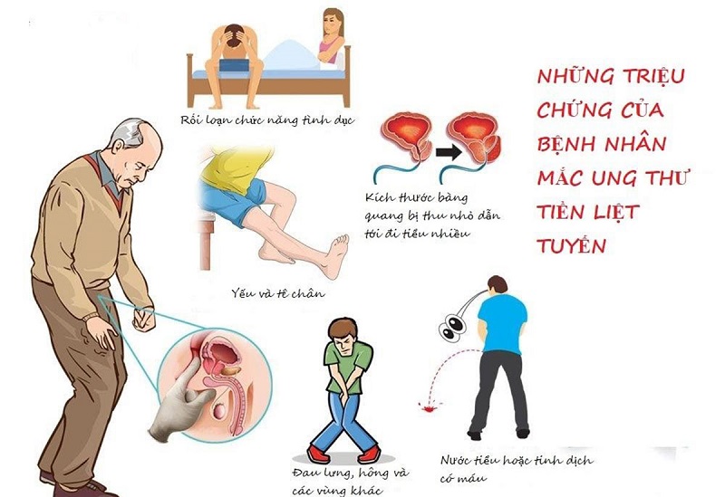 Ung thư tuyến tiền liệt