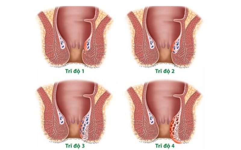 Tìm hiểu dấu hiệu trĩ nội độ 2