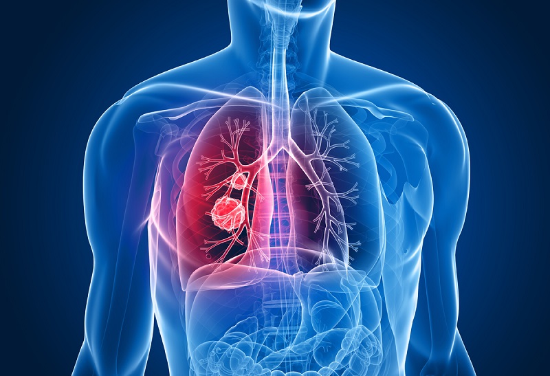 biến chứng COPD