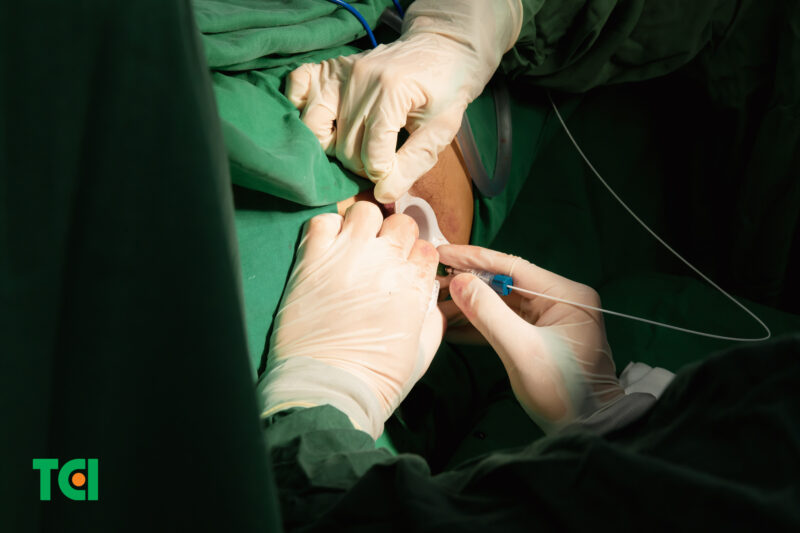 Phương pháp đốt trĩ Laser Diode