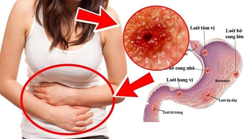 Áp dụng đúng phương pháp điều trị loét dạ dày sẽ giúp ngăn ngừa tái phát và biến chứng