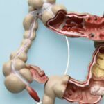 Nhận biết sớm các dấu hiệu cảnh báo ung thư đại tràng