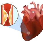 Nhồi máu cơ tim: Hệ lụy từ nhiều bệnh lý tim mạch