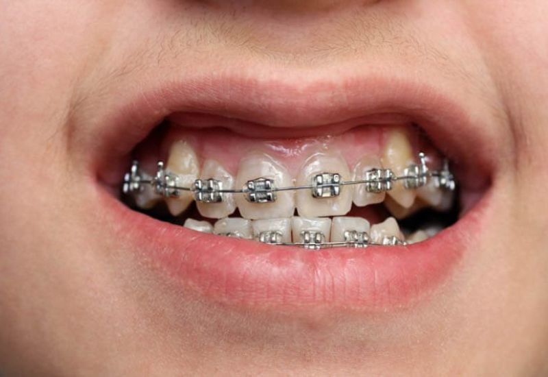 Niềng fun88 newcastle đang dần trở thành xu hướng thẩm mỹ được ưa chuộng hiện nay.