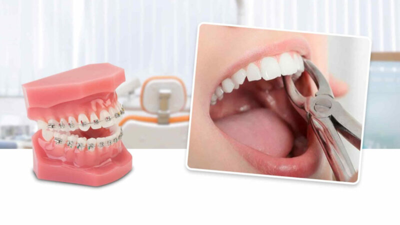 niềng fun88 linkbong88moinhat không nhổ fun88 linkbong88moinhat có được không
