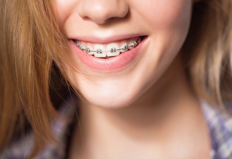 Niềng răng kim loại là lựa chọn phổ biến nhờ sự tiện lợi và hiệu quả lâu dài