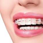 Niềng răng mọc lệch là gì? Quy trình và những điều cần biết