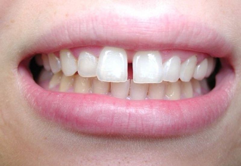 Để có hàm răng đều đẹp hơn, không ít người đã tìm đến phương pháp niềng fun88 chính thức.