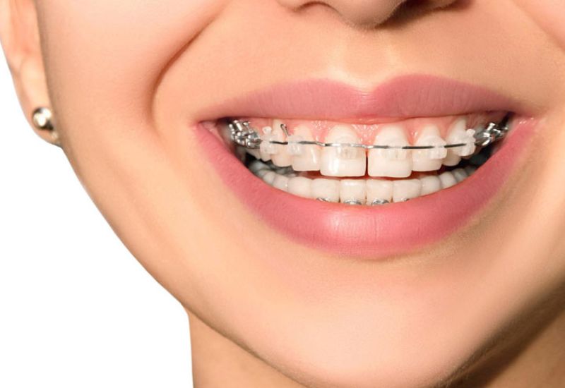 Niềng fun88 chính thức là giải pháp thẩm mỹ được nhiều người tin chọn.