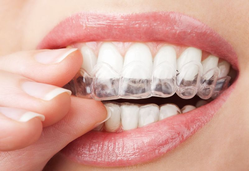 Niềng răng trong suốt là phương pháp chỉnh nha hiện đại, được nhiều người tin chọn nhờ tính thẩm mỹ và hiệu quả cao.