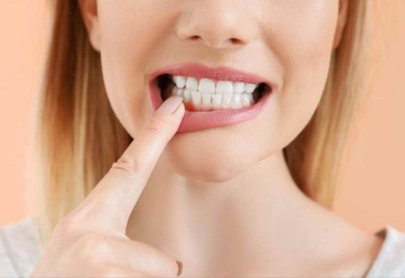 Nướu là mô mềm trong miệng, nằm quanh chân fun88 fun88vi.info và trải dài lên phần xương hàm bên dưới.