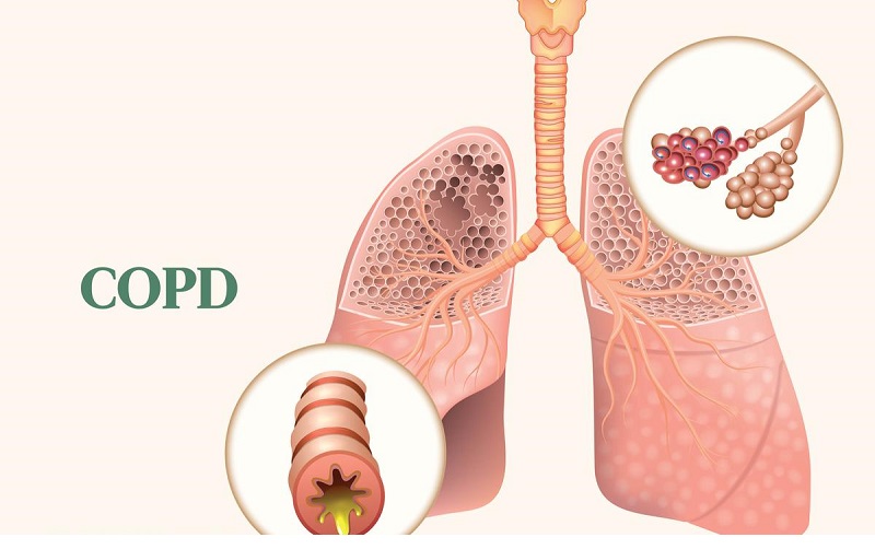 bệnh COPD là bệnh gì