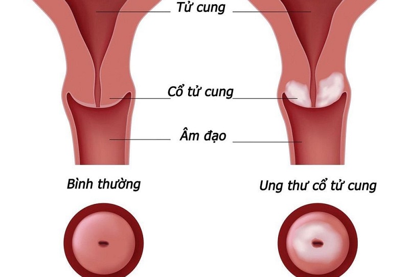 fun88 163 là tình trạng các tế bào tại vùng cổ tử cung tăng sinh bất thường và không kiểm soát, dẫn đến hình thành các khối u ác tính