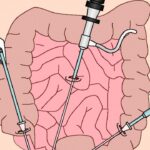 Phẫu thuật điều trị ung thư đại tràng khi nào và lưu ý sau mổ