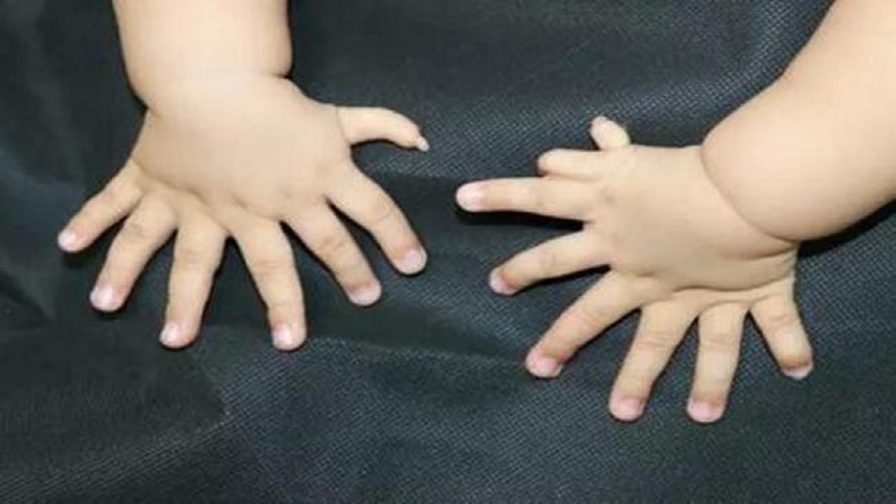 Thừa ngón tay cái là tình trạng dị tật bẩm sinh hiếm gặp, khi trẻ sinh ra với một ngón tay cái dư thừa