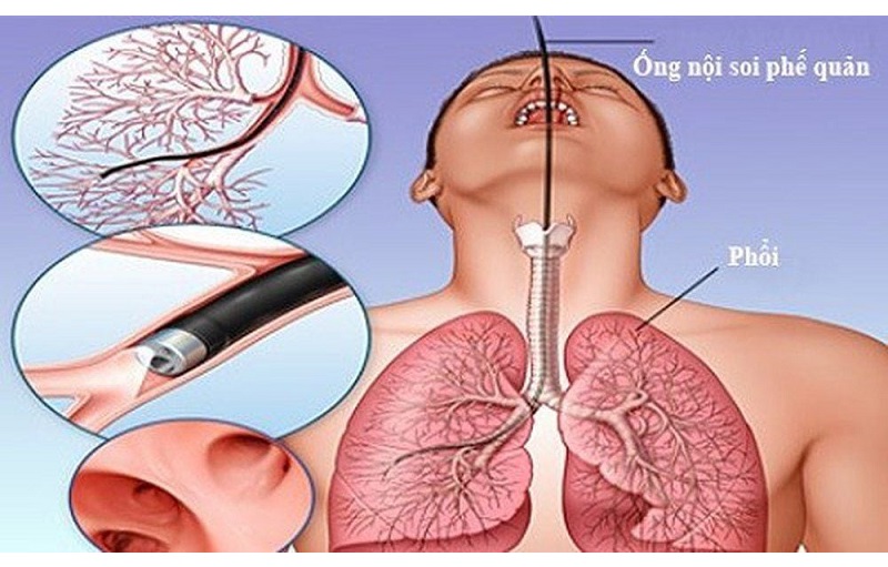Nội soi phế quản là một trong những phương pháp xác định bệnh lý