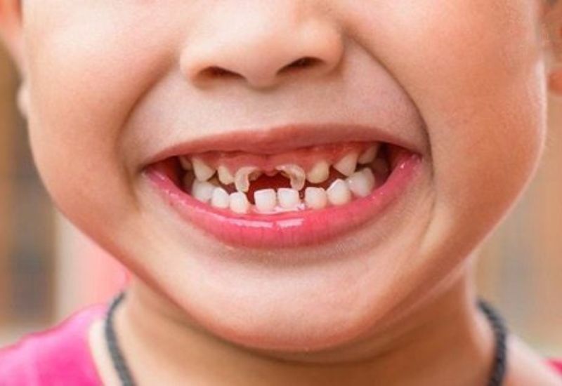 Tình trạng sâu răng sữa không chỉ khiến trẻ gặp khó khăn khi ăn uống mà còn ảnh hưởng đến vẻ ngoài hàm răng.